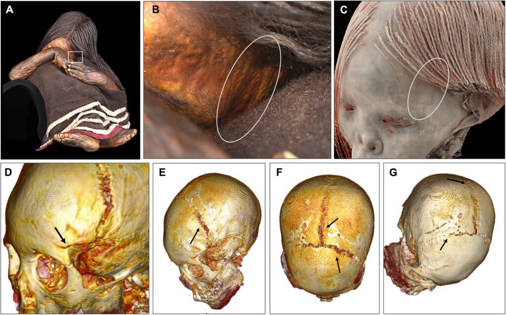 Visualización de la lesión cutánea y craneal en el niño de El Plomo (NEP). ( A ) Fotografía anterior de NEP; el área de la lesión está marcada con un rectángulo blanco. ( B ) Primer plano de la lesión cutánea; la indentación está marcada con un óvalo blanco. ( C ) Reconstrucción 3D de TC del área de la lesión (óvalo blanco). ( D ) Reconstrucción 3D de TC que muestra la línea de fractura frontal (flecha negra). ( E ) Reconstrucción 3D de TC que muestra la diástasis traumática de la sutura coronal (flecha negra). ( F ) Reconstrucción 3D de TC que muestra la diástasis traumática de las suturas coronal y sagital (flechas negras). ( G ) Reconstrucción 3D de TC que muestra el punto de terminación de la diástasis en las suturas coronal y sagital (flechas negras). Créditos fotográficos: [(A) y (B)] Colección Museo Nacional de Historia Natural, Chile/Archivo Centro Nacional de Conservación y Restauración (CNCR), P. Monteverde, 2023.